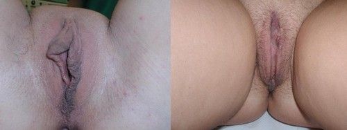 Макросъемка заживших тканей после лазерной лабиопластики