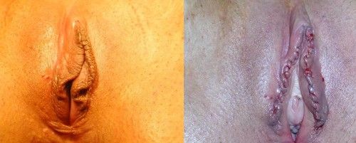 Коррекция возрастных изменений половых губ: клинический случай