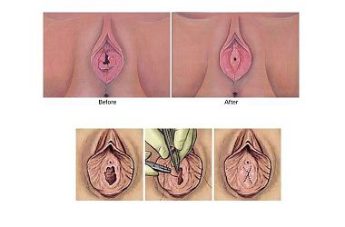 Восстановление девственности